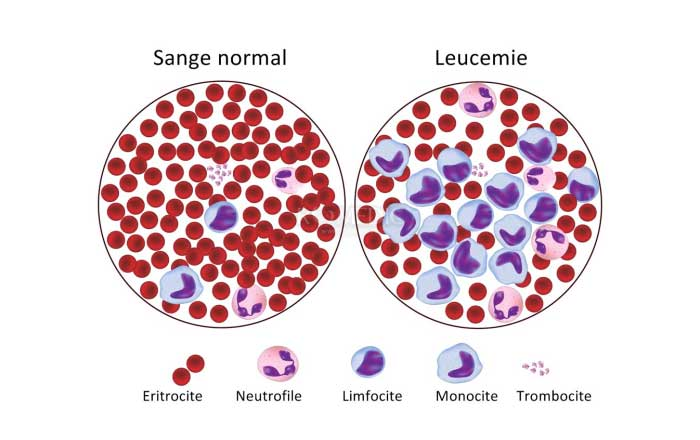 Ce este leucemia?