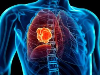 Ce-este-cancerul-pulmonar?