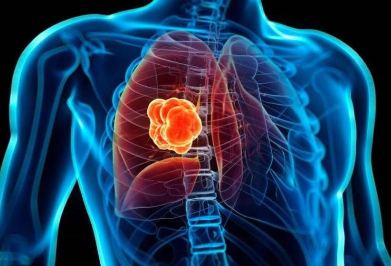 Ce este cancerul pulmonar?